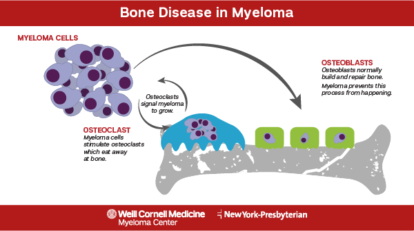 Bone Disease Caused by Myeloma