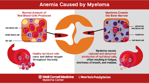 anemia caused by myeloma