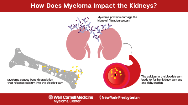 kidney impact from myeloma