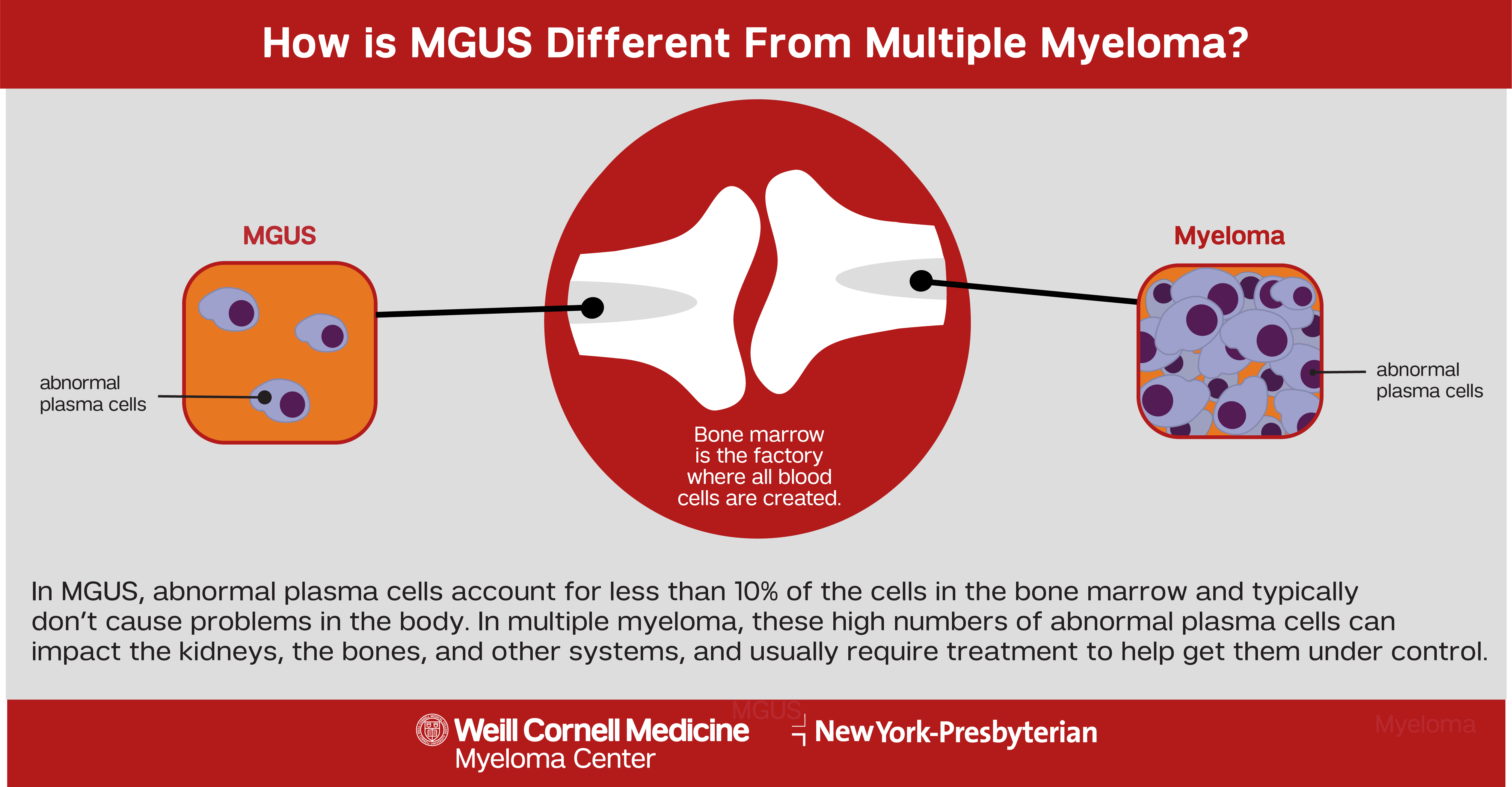 MGUS vs Multiple Myeloma